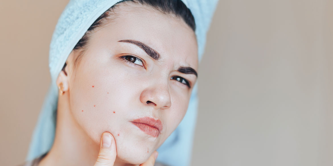 Jak wygląda skóra trądzikowa - charakterystyka